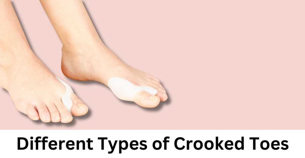 Different Types of Crooked Toes